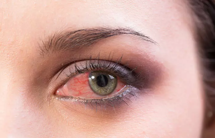2. Are Your Eyes Red And Dry
