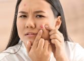 पिम्पल/मुंहासे हटाने के कुछ आसान तरीके - How to Remove Pimples in ...