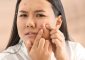 पिम्पल/मुंहासे हटाने के कुछ आसान तरीके - How to Remove Pimples in ...