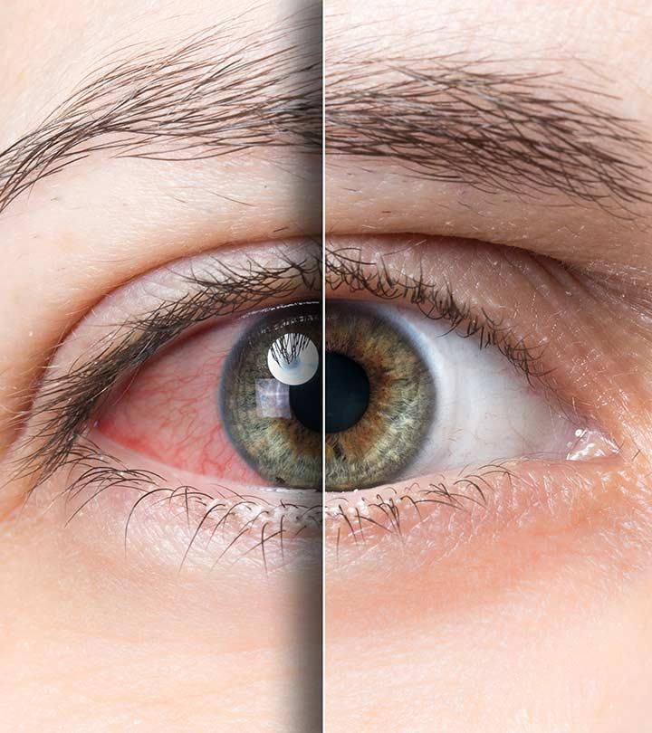 8 Exercises All People With Tired Eyes Need to Do