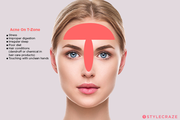 acne diagram of the face