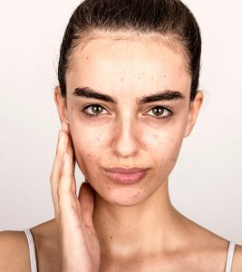 Acne Face Map: What Your Breakouts Ar...
