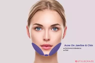 Acne on your jawline and chin
