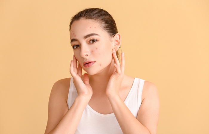 Woman with acne may benefit from bentonite clay mask