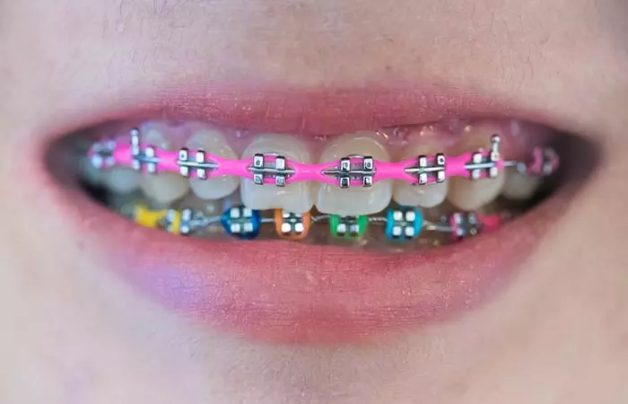 Colored Braces 