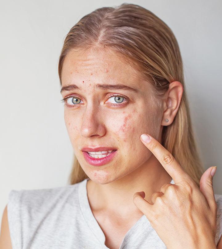 Stress Acne On Face Pictures