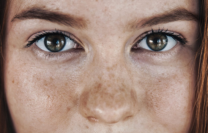 How To Treat Pigment Spots
