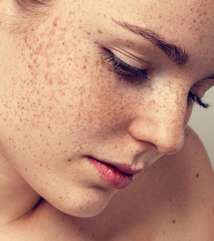 चेहरे के काले दाग धब्बे कैसे हटाएं - How to Remove Dark Spots in Hindi