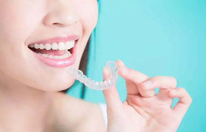 Transparent braces are the way to go