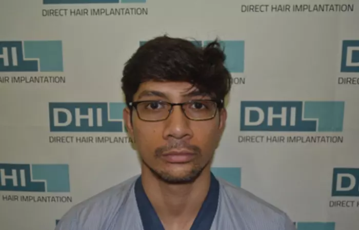 Beard Transplant Using DHI Technique