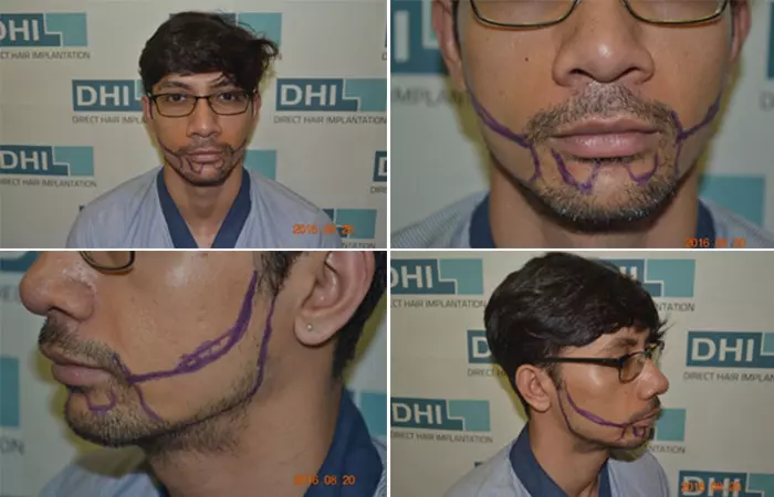 Beard Transplant Using DHI Technique d