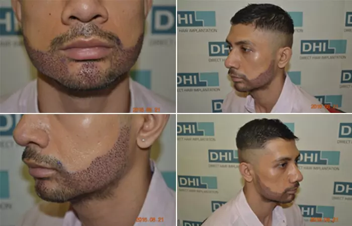 Beard Transplant Using DHI Technique e