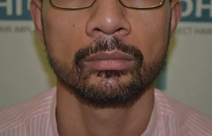 Beard Transplant Using DHI Technique g