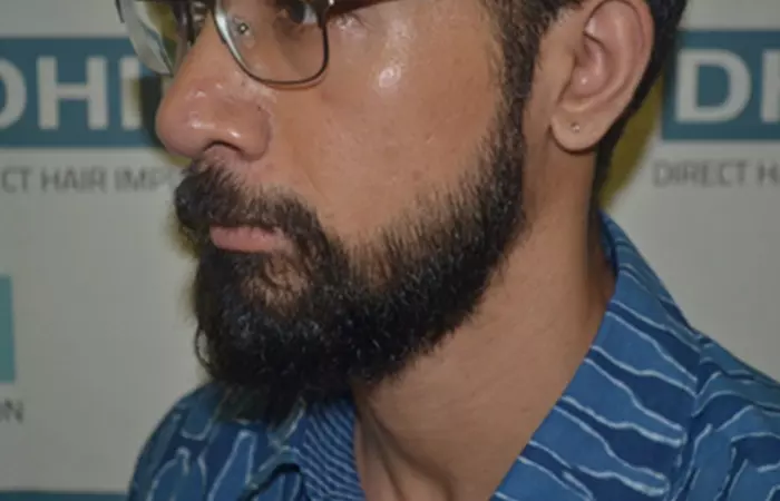 Beard Transplant Using DHI Technique i
