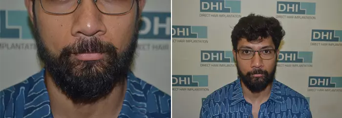 Beard Transplant Using DHI Technique i