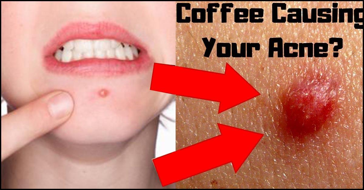 does-coffee-cause-acne