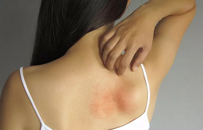 Eczema