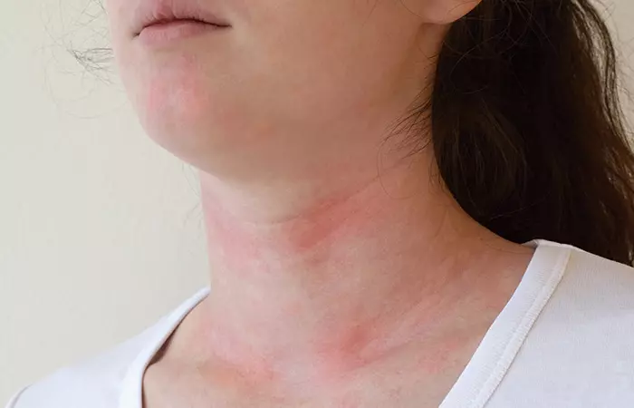 Hives