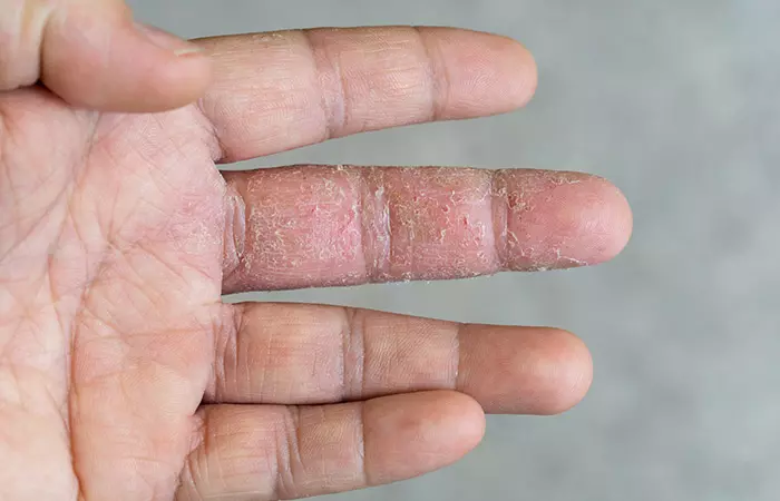It Can Adversely Damage Our Skin