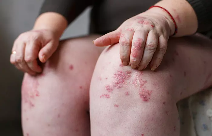 Psoriasis