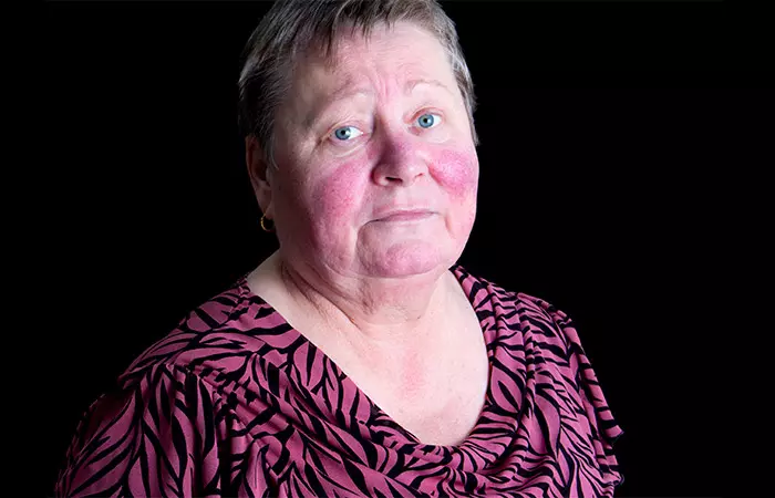 Rosacea