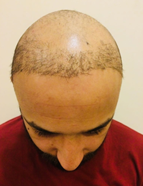 The Best Place To Get A Hair Transplant In India 2