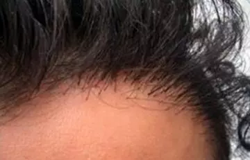 The Best Place To Get A Hair Transplant In India 3