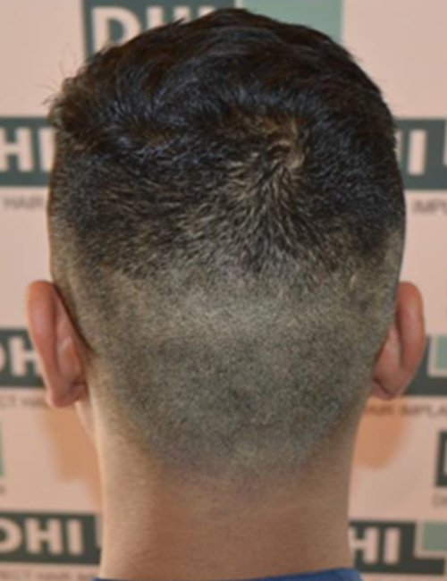 The Best Place To Get A Hair Transplant In India 4