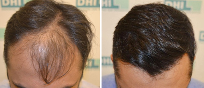 The Best Place To Get A Hair Transplant In India 6