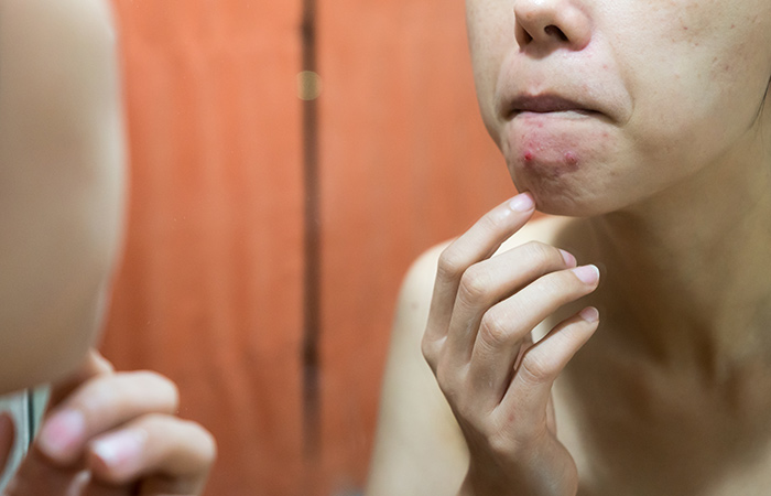 Potential risks of using jojoba oil for acne