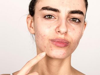 Hormonal Acne How To Treat It Effectively