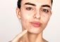 Hormonal Acne: Causes, How To Treat I...