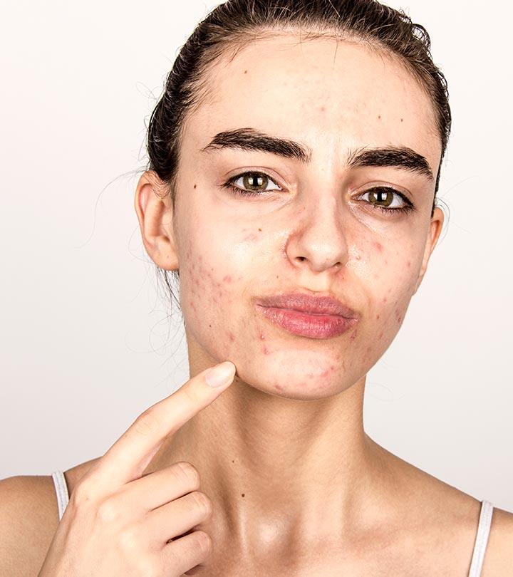 Hormonal How Acne To Avoid