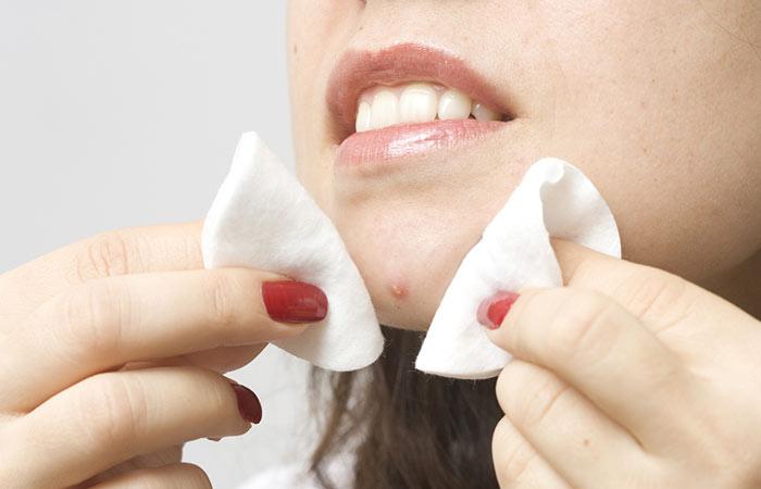 How To Pop A Pimple Safely