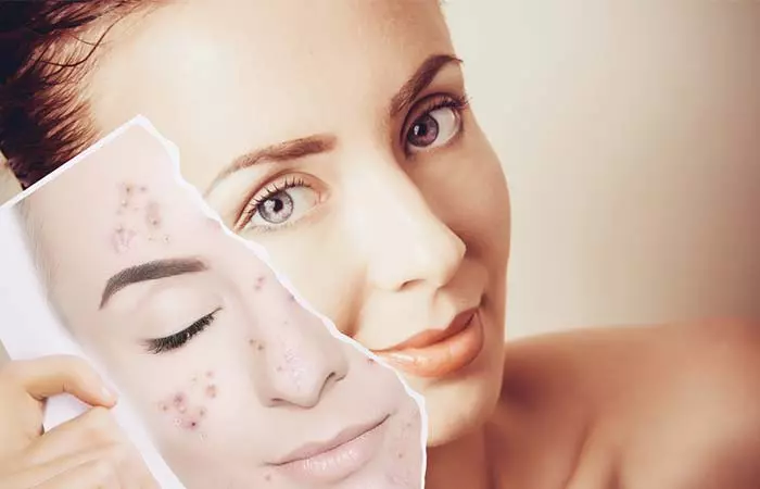 It Can Help Fight Acne