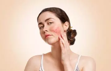 Woman experiencing skin inflammation after vampire facial