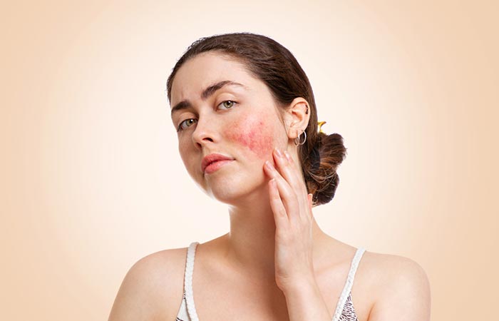 Woman experiencing skin inflammation after vampire facial