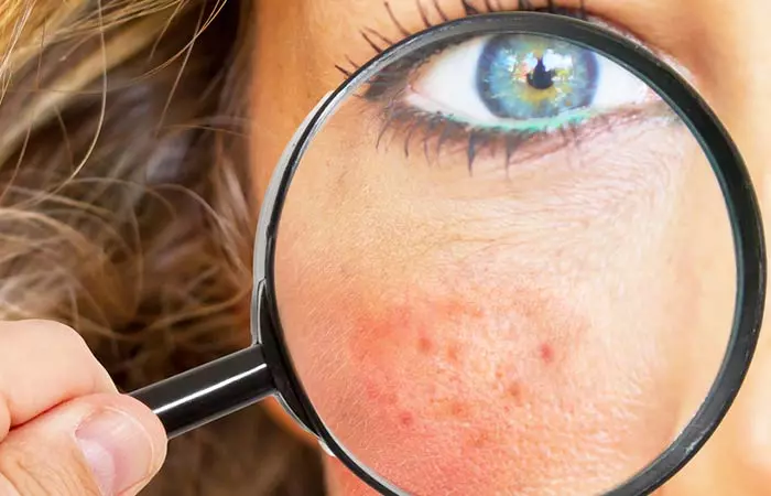 It Provides Immediate Relief To Inflamed Skin