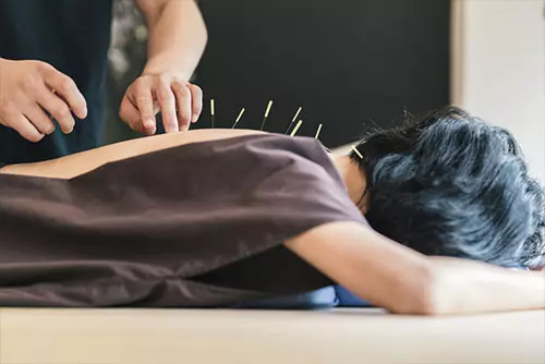 The Acupuncture Treatment