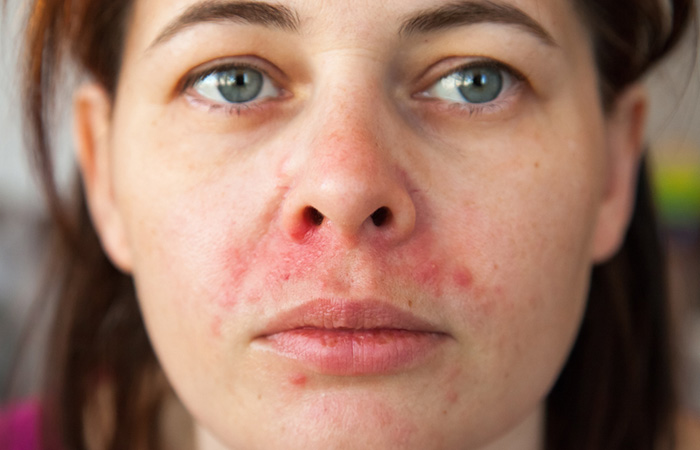 Woman with atopic dermatitis and other skin issues
