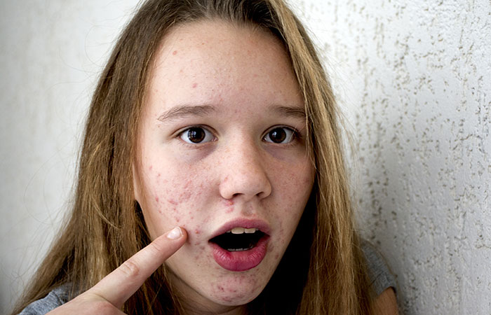 Hormonal acne is more common in women as compared to men