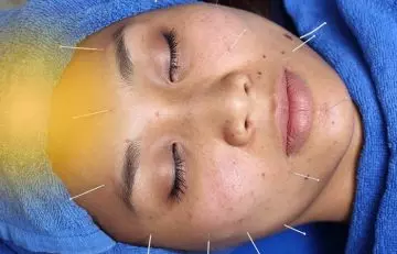 What Is Facial Acupuncture