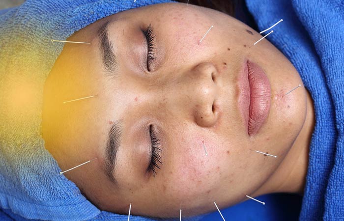 What Is Facial Acupuncture