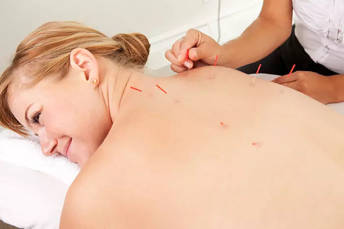 Doctor performing acupuncture