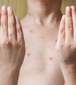 Home Remedies For Chicken Pox in Hindi