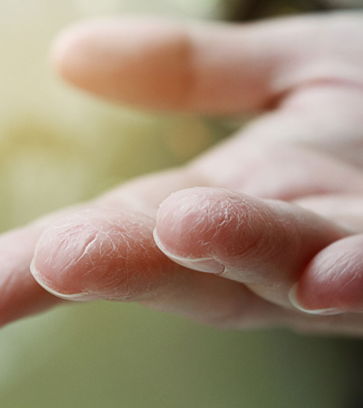 फटी उंगलियों के लिए घरेलू उपाय – Home Remedies for Painful And ...