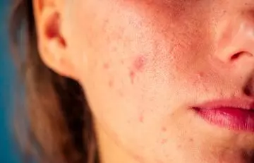 Treats-Dermatitis-And-Acne