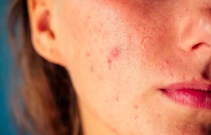 Treats-Dermatitis-And-Acne