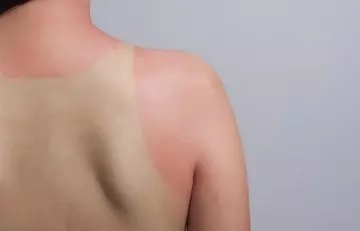 Treats-Sunburns-And-Aging-Skin