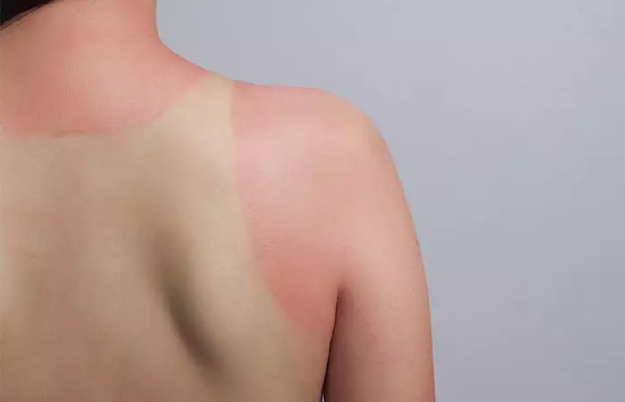 Treats-Sunburns-And-Aging-Skin